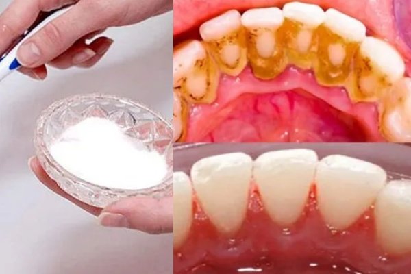 Elimine Placa Bacteriana e Tártaro em 2 Minutos!