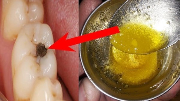 Use Isso Para Eliminar a Cárie Dentária em 5 Minutos!